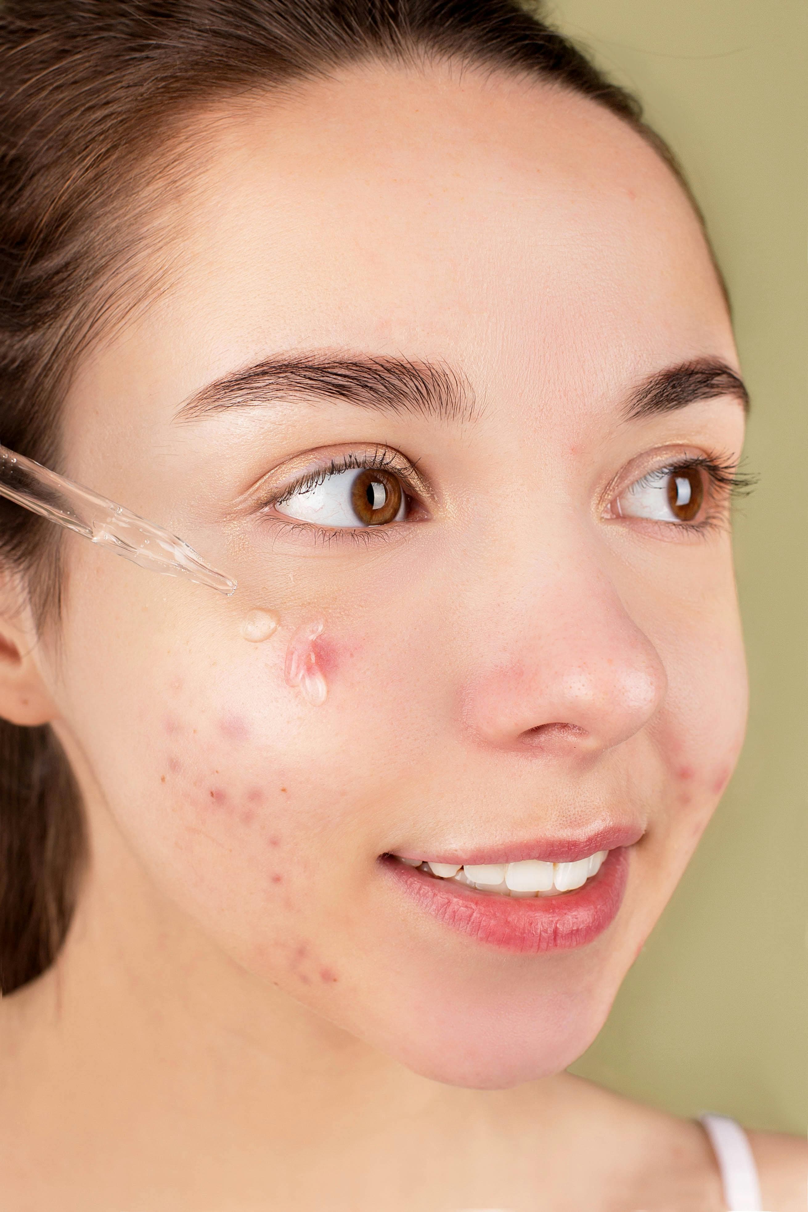 Tratamento para acne — benefício 4