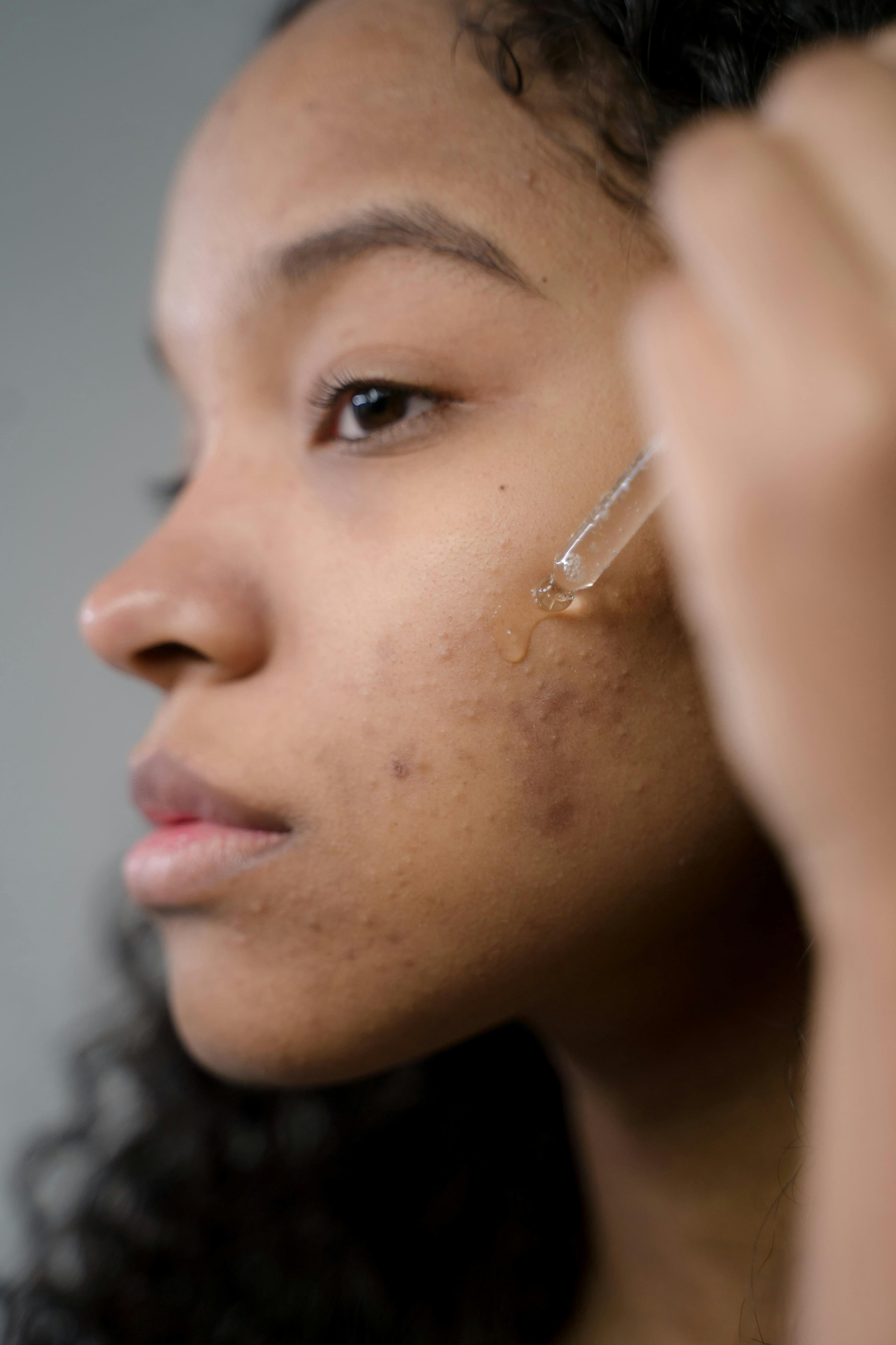 Tratamento para acne — região tratada, imagem 1